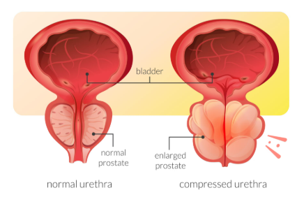 Illustration: normal vs. enlarged prostate (variant)